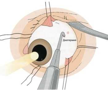 Хирургическое лечение катаракты может привести к четырехкратному возрастанию риска отслойки сетчатки