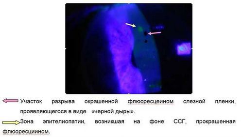 Методы диагностики синдрома сухого глаза