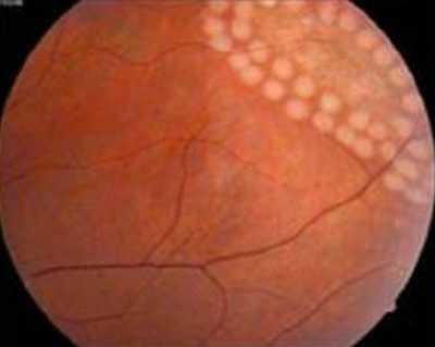 Отслойка сетчатки. Диагностика и лечение отслойки сетчатки глаза