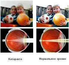 бесшовная операция катаракты