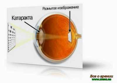 катаракта бесплатная операция отзывы