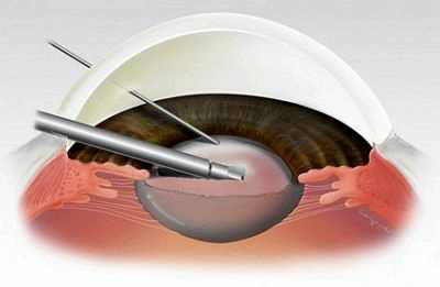 катаракта как проходит операция видео