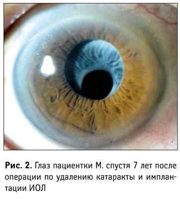 катаракта операция на второй глаз