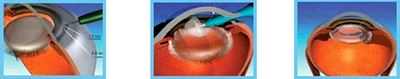 катаракта операция отзывы пермь
