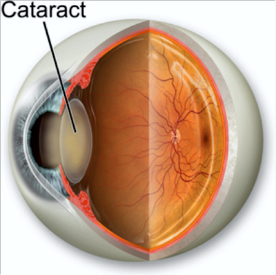 катаракта операция отзывы