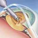катаракта операция в перми