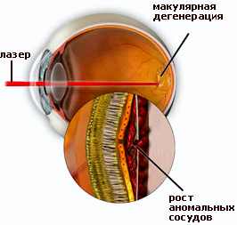 катаракта операция в томске