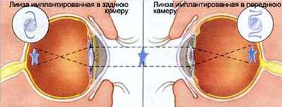 катаракта операция в воронеже