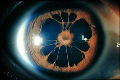операция катаракта послеоперационный период