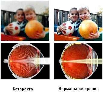 сколько стоит операция катаракта глаза