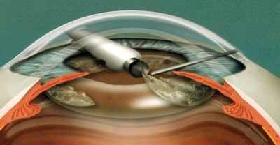 интракапсулярная экстракция катаракты показания
