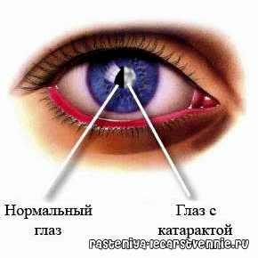 интракапсулярная экстракция катаракты преимущества