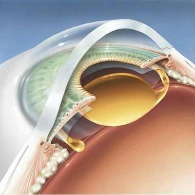факоэмульсификация катаракты с имплантацией иол отзывы