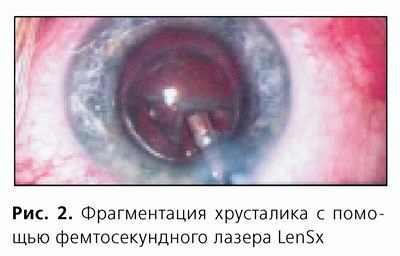 фемтосекундный лазер катаракта
