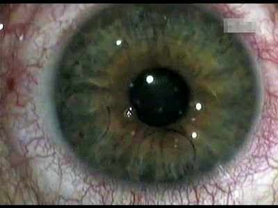 как делают операцию по катаракте лазером
