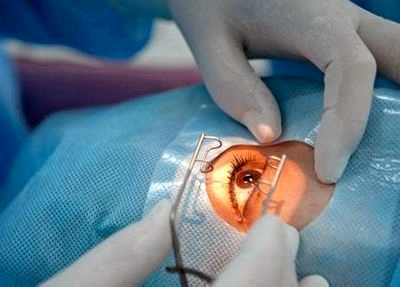 видео удаление катаракты фемтосекундным лазером