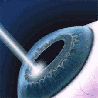 лазерное лечение катаракты противопоказания