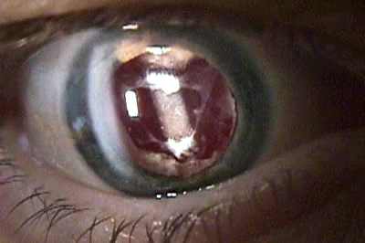 лазерное удаление катаракты отзывы
