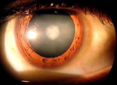 лечение катаракты по омс