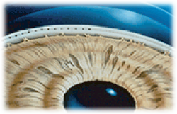 лечение катаракты в воронеже отзывы