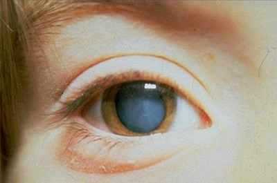 вторичная катаракта фото