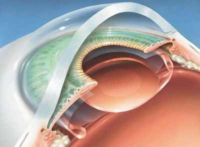 экстракапсулярная экстракция катаракты без имплантации иол