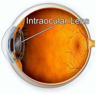 лазерная экстракция катаракты с имплантацией интраокулярной линзы