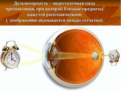 современные методы лечения катаракты
