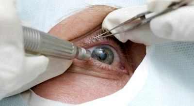 современные методы лечения катаракты