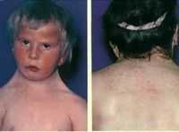 Болезнь Клиппеля-Фейля (синдром короткой шеи). Болезнь Коатса. Болезнь Микулича.