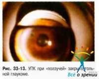 Патогенез амблиопии. Патогенез первичной глаукомы. Патогенез ретинопатии недоношенных.