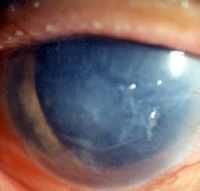 Дистрофия роговицы эндотелиальная. Дифтерия органа зрения. Диффузные воспалительные заболевания соединительной ткани и сосудов .