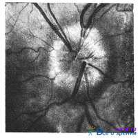Избавление от шлаков. Изменения органа зрения при заболеваниях центральной нервной системы . Изменения органа зрения при общих заболеваниях организма.