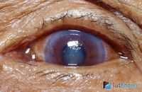 Простая глаукома. Простые рецепты здоровья №1(37), 2009 Глазные заболевания. Противоаллергические препараты.