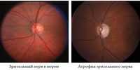 Врождённые заболевания зрительного нерва. Врождённые и посттравматические поражения глаз. Врожденные катаракты.