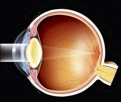 какие очки нужны при катаракте