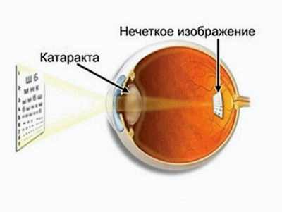 очки при катаракте
