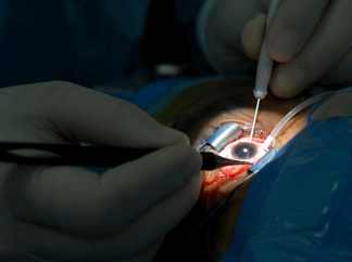 хирургия катаракты книга