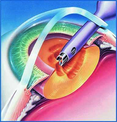 хирургия катаракты на современном этапе