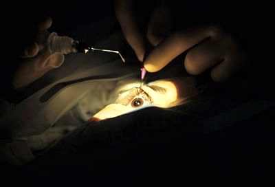 хирургия катаракты в израиле