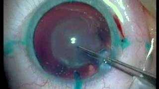 хирургия катаракты видео