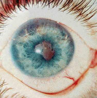 осложненная увеальная катаракта