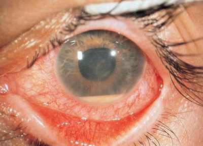 осложненная увеальная катаракта