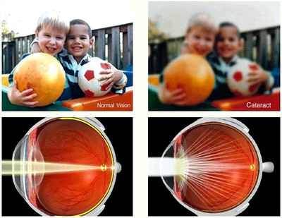 удаление хрусталика катаракта как человек видит