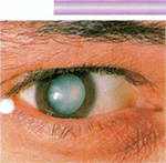 замена хрусталика при катаракте реабилитация