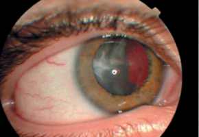 заднекапсульная катаракта