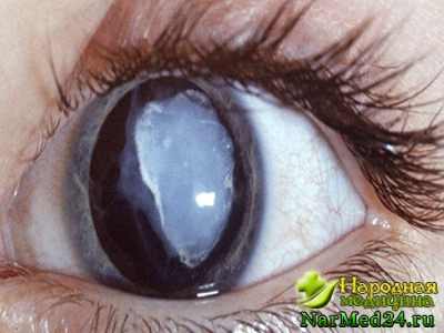 катаракта причины симптомы лечение и профилактика видео