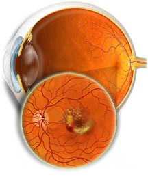 Имплантаты улучшают зрение при возрастной макулярной дегенерации