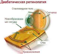 Изменение толщины хориоидеи после панретинальной фотокоагуляции у пациентов с диабетической ретинопатией