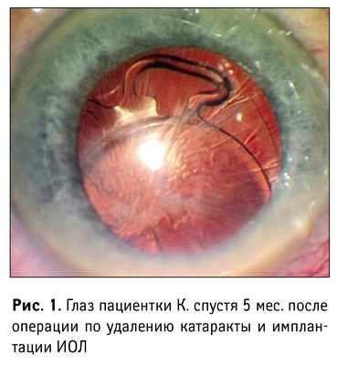 болезнь катаракта глаз после операции